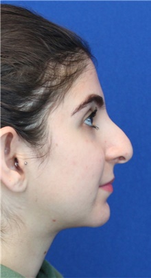 Rhinoplasty Before Photo by Ali Sajjadian, M.D., F.A.C.S.; Newport Beach, CA - Case 44223