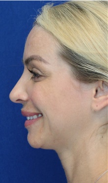 Rhinoplasty After Photo by Ali Sajjadian, M.D., F.A.C.S.; Newport Beach, CA - Case 44225