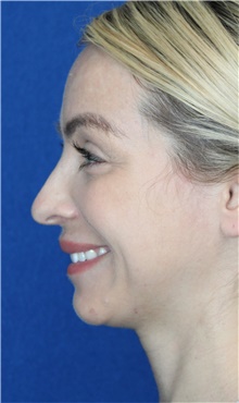 Rhinoplasty Before Photo by Ali Sajjadian, M.D., F.A.C.S.; Newport Beach, CA - Case 44225