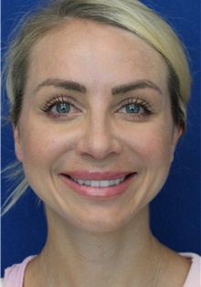 Rhinoplasty After Photo by Ali Sajjadian, M.D., F.A.C.S.; Newport Beach, CA - Case 44225