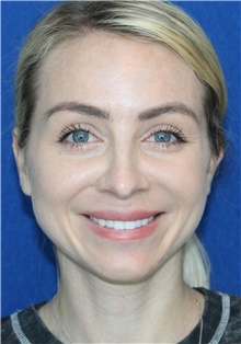 Rhinoplasty Before Photo by Ali Sajjadian, M.D., F.A.C.S.; Newport Beach, CA - Case 44225