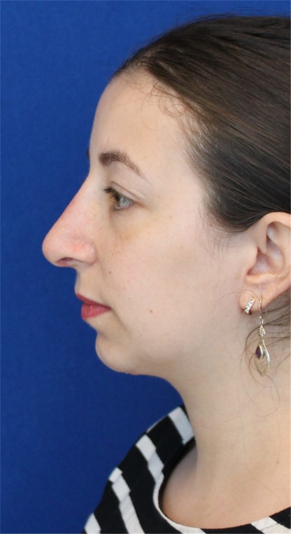 Rhinoplasty Before and After Photos by Ali Sajjadian, M.D., F.A.C.S.;  Newport Beach, CA - Case 44226