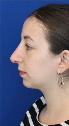 Rhinoplasty After Photo by Ali Sajjadian, M.D., F.A.C.S.; Newport Beach, CA - Case 44226