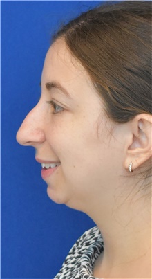 Rhinoplasty Before Photo by Ali Sajjadian, M.D., F.A.C.S.; Newport Beach, CA - Case 44226