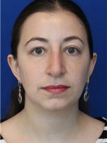 Rhinoplasty After Photo by Ali Sajjadian, M.D., F.A.C.S.; Newport Beach, CA - Case 44226