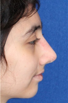 Rhinoplasty After Photo by Ali Sajjadian, M.D., F.A.C.S.; Newport Beach, CA - Case 44246