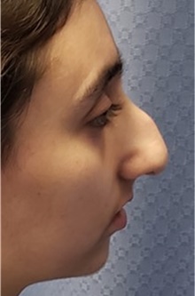 Rhinoplasty Before Photo by Ali Sajjadian, M.D., F.A.C.S.; Newport Beach, CA - Case 44246