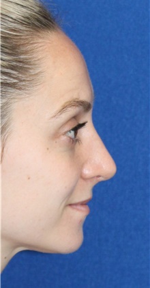 Rhinoplasty After Photo by Ali Sajjadian, M.D., F.A.C.S.; Newport Beach, CA - Case 44247