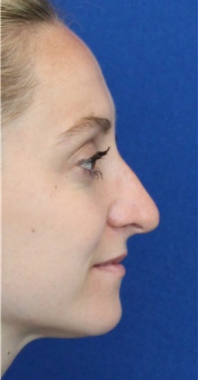 Rhinoplasty Before Photo by Ali Sajjadian, M.D., F.A.C.S.; Newport Beach, CA - Case 44247