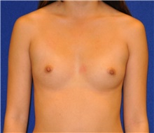 Breast Augmentation Before Photo by Ali Sajjadian, M.D., F.A.C.S.; Newport Beach, CA - Case 44248