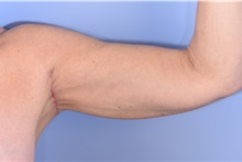 Arm Lift After Photo by Henry Wilson, MD, MHCM, FACS; ,  - Case 50346