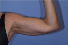 Arm Lift Before Photo by Henry Wilson, MD, MHCM, FACS; ,  - Case 50346