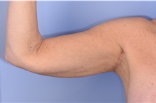 Arm Lift After Photo by Henry Wilson, MD, MHCM, FACS; ,  - Case 50346