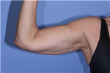 Arm Lift Before Photo by Henry Wilson, MD, MHCM, FACS; ,  - Case 50346