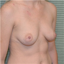 Breast Augmentation Before Photo by Jonathan Weinrach, MD; Scottsdale, AZ - Case 36768