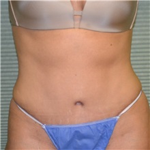 Tummy Tuck After Photo by Jonathan Weinrach, MD; Scottsdale, AZ - Case 36769