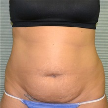 Tummy Tuck Before Photo by Jonathan Weinrach, MD; Scottsdale, AZ - Case 36769