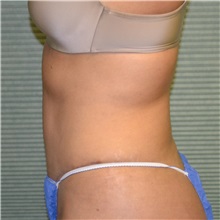Tummy Tuck After Photo by Jonathan Weinrach, MD; Scottsdale, AZ - Case 36769