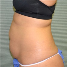 Tummy Tuck Before Photo by Jonathan Weinrach, MD; Scottsdale, AZ - Case 36769