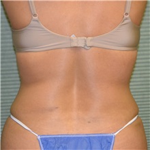 Tummy Tuck After Photo by Jonathan Weinrach, MD; Scottsdale, AZ - Case 36769