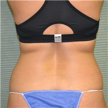 Tummy Tuck Before Photo by Jonathan Weinrach, MD; Scottsdale, AZ - Case 36769