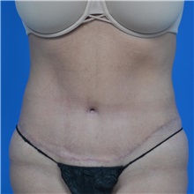 Tummy Tuck After Photo by Jonathan Weinrach, MD; Scottsdale, AZ - Case 36770