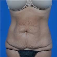 Tummy Tuck Before Photo by Jonathan Weinrach, MD; Scottsdale, AZ - Case 36770