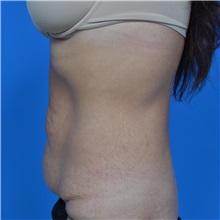 Tummy Tuck Before Photo by Jonathan Weinrach, MD; Scottsdale, AZ - Case 36770