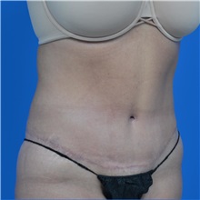 Tummy Tuck After Photo by Jonathan Weinrach, MD; Scottsdale, AZ - Case 36770