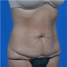 Tummy Tuck Before Photo by Jonathan Weinrach, MD; Scottsdale, AZ - Case 36770