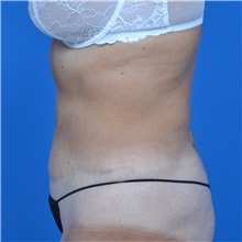 Tummy Tuck After Photo by Jonathan Weinrach, MD; Scottsdale, AZ - Case 36771