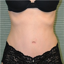 Tummy Tuck After Photo by Jonathan Weinrach, MD; Scottsdale, AZ - Case 36773
