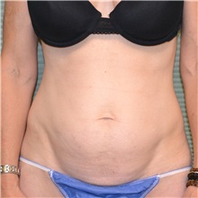 Tummy Tuck Before Photo by Jonathan Weinrach, MD; Scottsdale, AZ - Case 36773