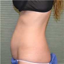 Tummy Tuck Before Photo by Jonathan Weinrach, MD; ,  - Case 36773