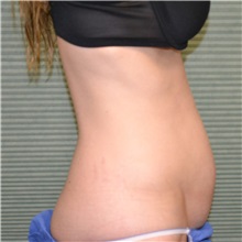 Tummy Tuck Before Photo by Jonathan Weinrach, MD; ,  - Case 36773