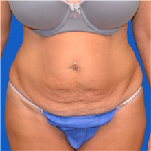 Tummy Tuck Before Photo by Jonathan Weinrach, MD; Scottsdale, AZ - Case 36780