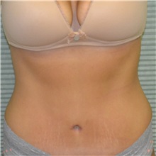 Tummy Tuck After Photo by Jonathan Weinrach, MD; Scottsdale, AZ - Case 36786