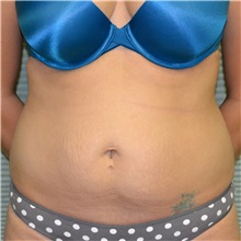 Tummy Tuck Before Photo by Jonathan Weinrach, MD; Scottsdale, AZ - Case 36786