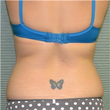 Tummy Tuck Before Photo by Jonathan Weinrach, MD; ,  - Case 36786