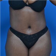 Tummy Tuck After Photo by Jonathan Weinrach, MD; Scottsdale, AZ - Case 36791
