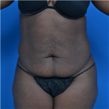 Tummy Tuck Before Photo by Jonathan Weinrach, MD; Scottsdale, AZ - Case 36791