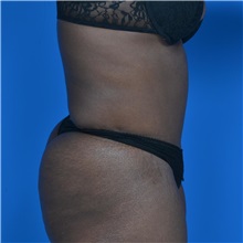 Tummy Tuck After Photo by Jonathan Weinrach, MD; ,  - Case 36791