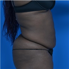 Tummy Tuck Before Photo by Jonathan Weinrach, MD; ,  - Case 36791