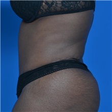 Tummy Tuck After Photo by Jonathan Weinrach, MD; ,  - Case 36791