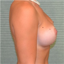 Breast Augmentation After Photo by Jonathan Weinrach, MD; ,  - Case 36792