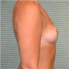 Breast Augmentation Before Photo by Jonathan Weinrach, MD; ,  - Case 36792