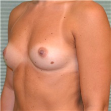 Breast Augmentation Before Photo by Jonathan Weinrach, MD; ,  - Case 36792