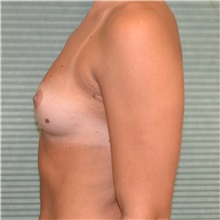 Breast Augmentation Before Photo by Jonathan Weinrach, MD; ,  - Case 36792