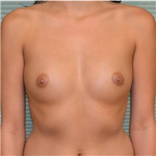 Breast Augmentation Before Photo by Jonathan Weinrach, MD; Scottsdale, AZ - Case 36798