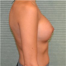 Breast Augmentation After Photo by Jonathan Weinrach, MD; Scottsdale, AZ - Case 36798